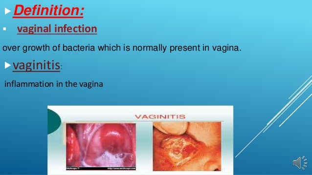 pictures of vaginal disease Pictures of vaginal disease